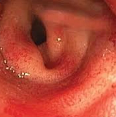 Viêm đại tràng do xạ trị (Radiation colitis)