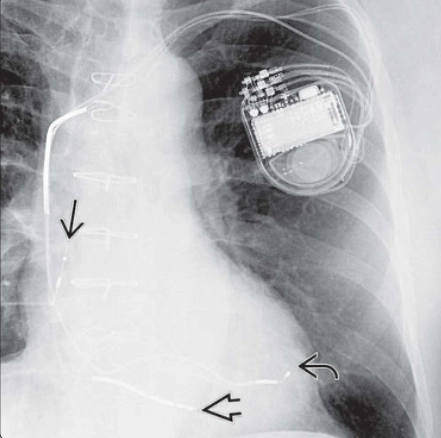 Các thiết bị tạo nhịp tim (Cardiac Conduction Devices)