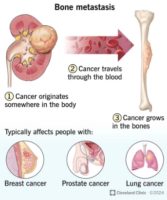 Di căn xương (Bone metastases)