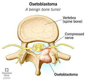 U nguyên bào xương (Osteoblastoma)