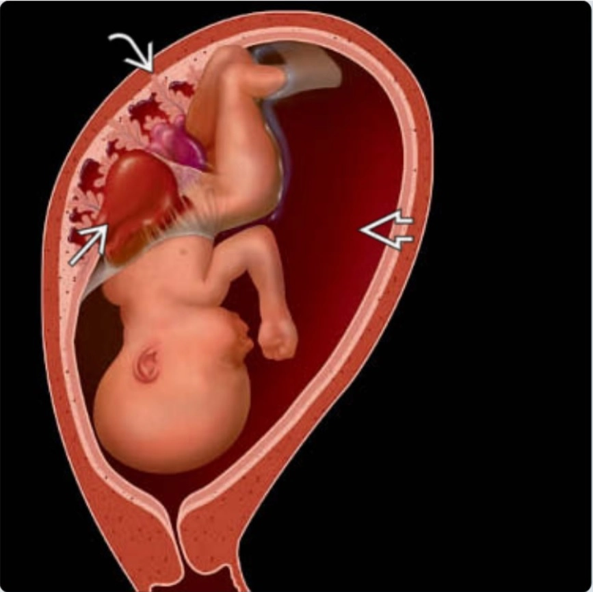 Bất thường phức hợp cơ thể: Body stalk anomaly (BSA) / Limb body wall complex (LBWC)