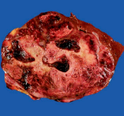 Sarcoma mạch máu gan (Hepatic angiosarcoma)