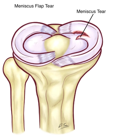 Rách sụn chêm kiểu vạt (Flap tear)