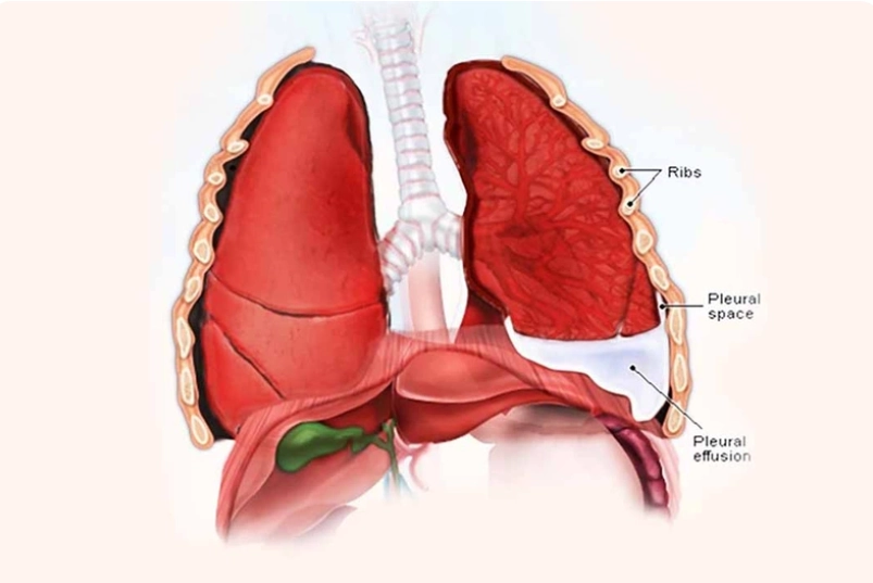 Tràn dịch màng phổi thai quý I (Hydrothorax / Pleural effusion)