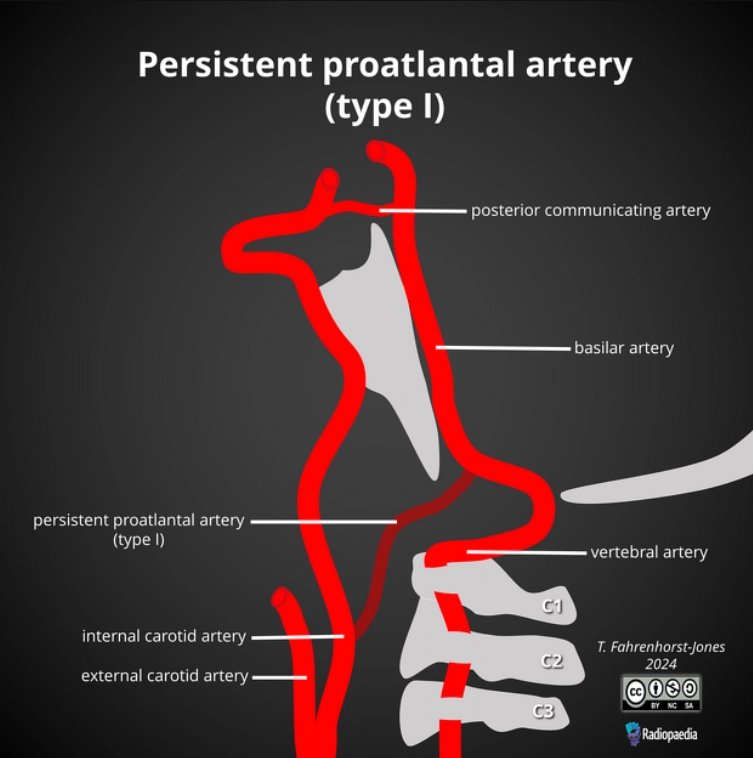 Tồn tại động mạch giáp trước/ Tồn tại động mạch trước đốt đột (Persistent proatlantal artery - ProA)