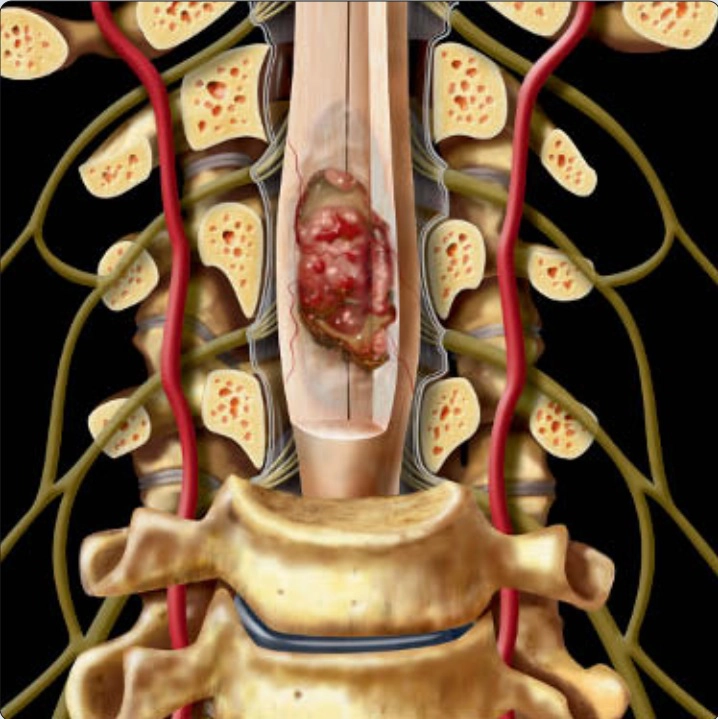 Bệnh lý trong tủy (Intramedullary lesions)