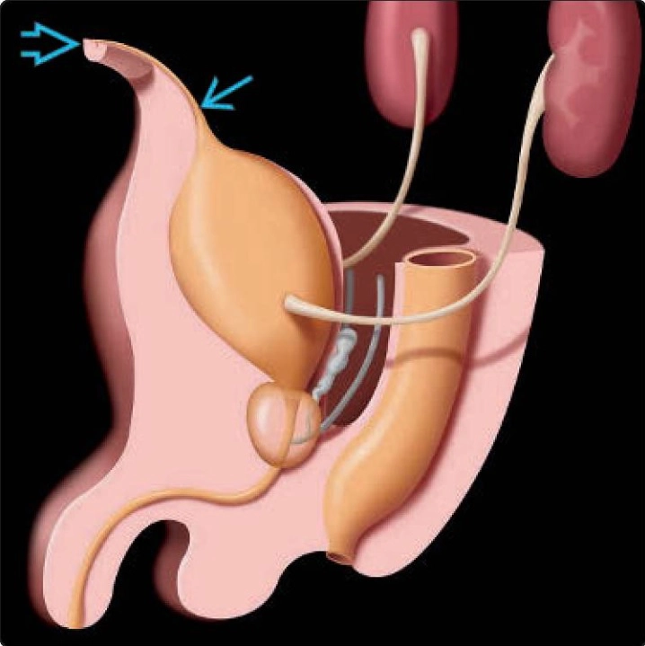 Bàng quang và niệu rốn (Bladder &amp; Urachus)