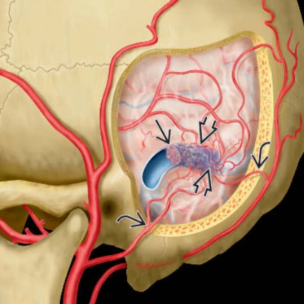 Rò động-tĩnh mạch màng cứng (Dural Arteriovenous Fistula - DAVF)