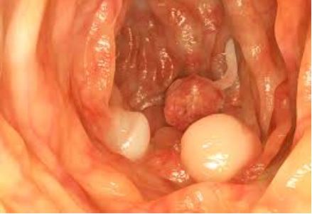  Ung thư biểu mô tuyến tá tràng (Duodenal adenocarcinoma)