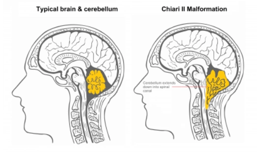 DỊ DẠNG CHIARI TUÝP II (CHIARI II MALFORMATION)