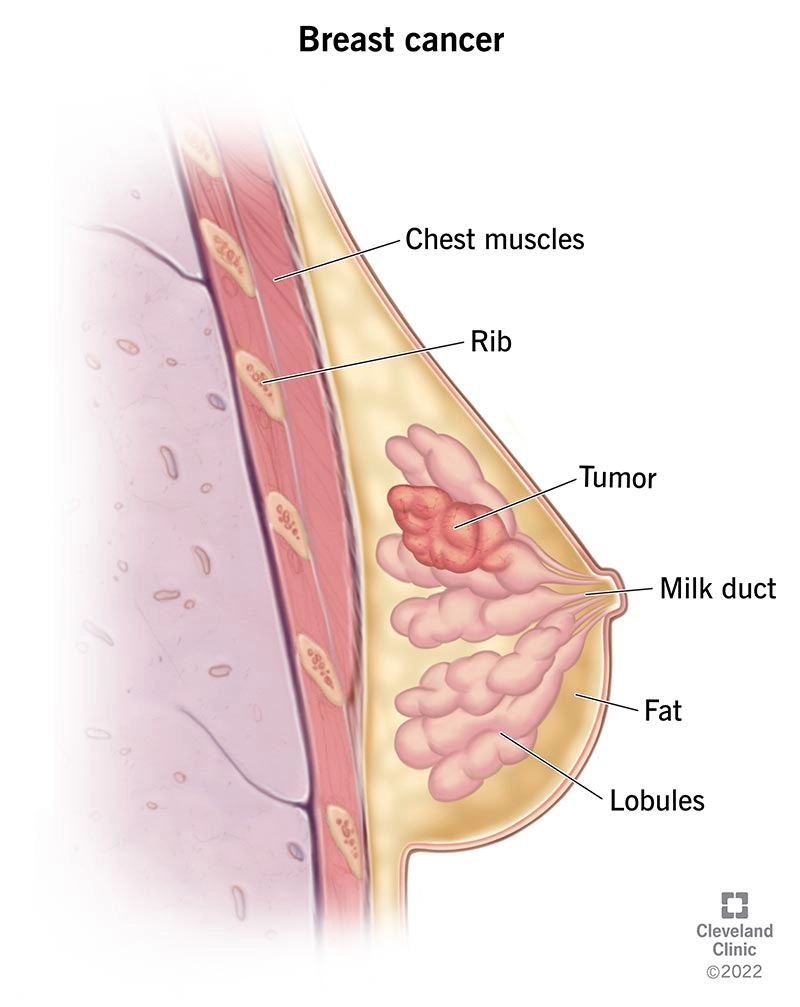 Phân loại giai đoạn Ung thư vú (Breast cancer (staging))