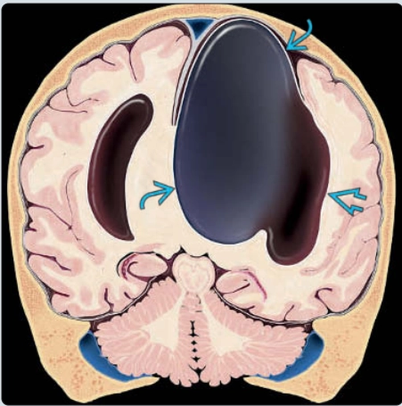 Nang khe liên bán cầu/ hội chứng AVID (Interhemispheric cyst &amp; AVID syndrome)
