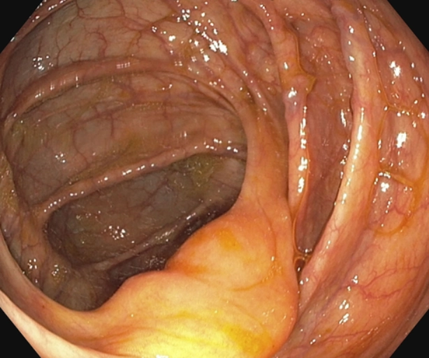 Lắng đọng mỡ van hồi-manh tràng (Lipomatosis of the ileocecal valve)