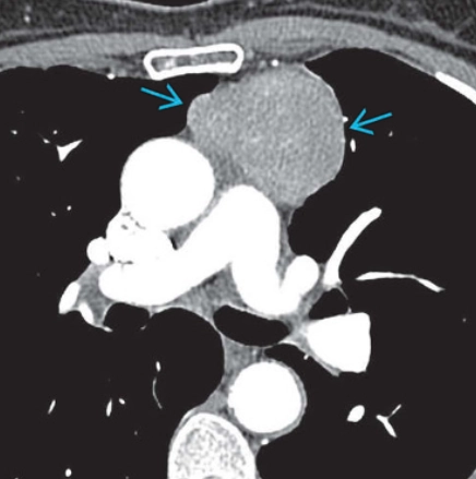 Dấu hiệu che phủ rốn phổi (Hilum Overlay Sign)