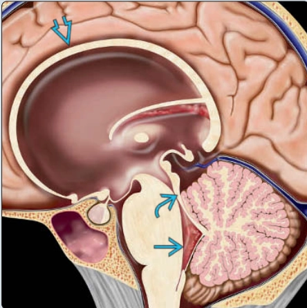 Tắc cống não ở thai nhi  (Aqueductal stenosis)