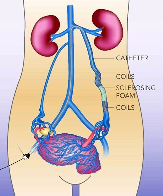 Hội chứng xung huyết vùng chậu (Pelvic congestion syndrome)