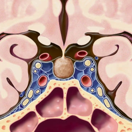 Tăng sản tuyến yên (Pituitary Hyperplasia)