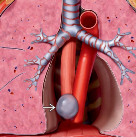 Nang đôi thực quản (Esophageal duplication cyst - EDC)