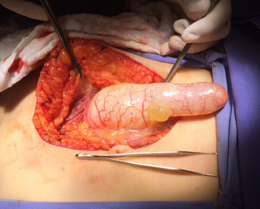 U nhầy ruột thừa (Appendiceal mucocele)