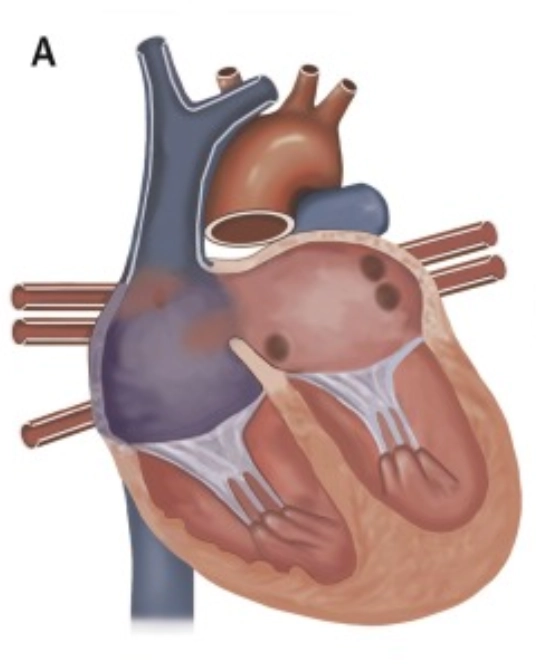 Thông liên nhĩ xoang tĩnh mạch (ASD-sv)
