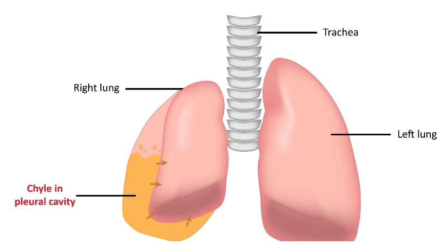 Rách ống ngực (Thoracic duct tear)/Tràn dịch dưỡng chấp màng phổi (Chylothorax)