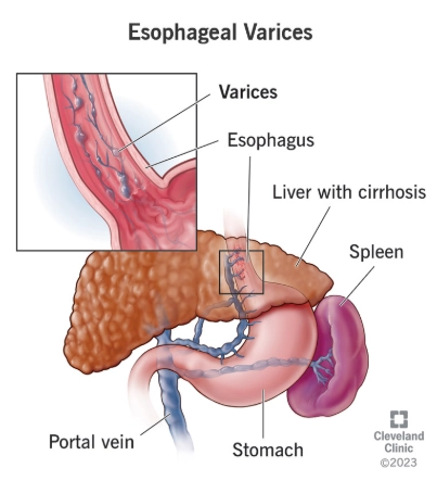Giãn tĩnh mạch thực quản (Esophageal varices)