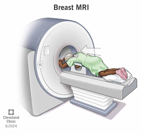 MRI vú (Breast MRI)
