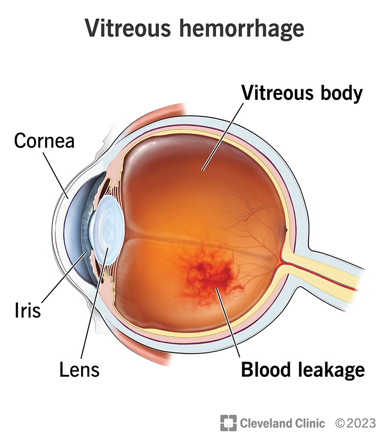 Xuất huyết dịch kính (Vitreous hemorrhage)