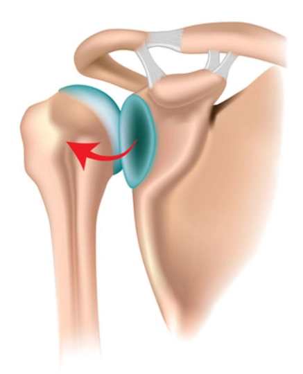 Trật khớp vai ra sau (Posterior shoulder dislocations)