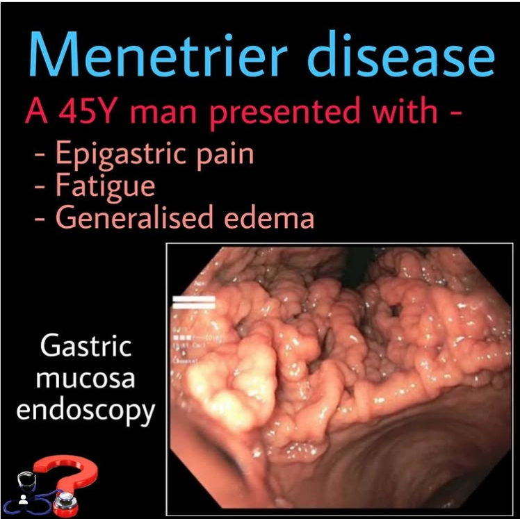 Bệnh Ménétrier (Ménétrier Disease)