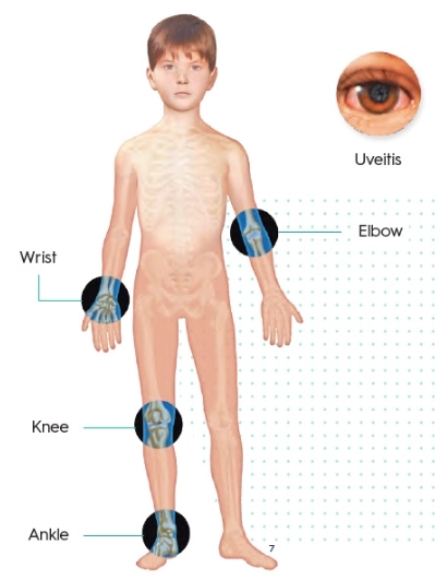  Viêm khớp tự phát thiếu niên (Juvenile idiopathic arthritis - JIA)