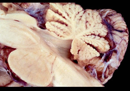 Hội chứng Louis-Bar (Thất điều giãn mạch/Ataxia-telangiectasia)