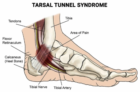 Hội chứng ống cổ chân (Tarsal tunnel syndrome)