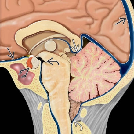 Giảm áp lực nội sọ (Spontaneous intracranial hypotension - SIH)