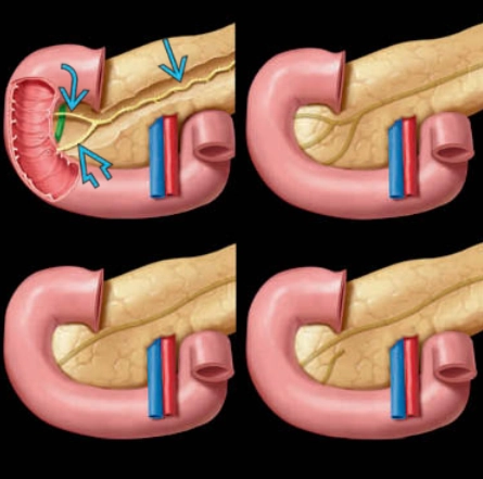 Tụy đôi (Pancreas divisum)