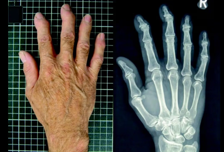 Thoái hóa khớp bàn tay dạng ăn mòn (Erosive osteoarthritis)