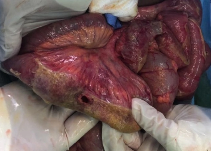 Chấn thương ruột và mạc treo (Bowel and mesenteric trauma)