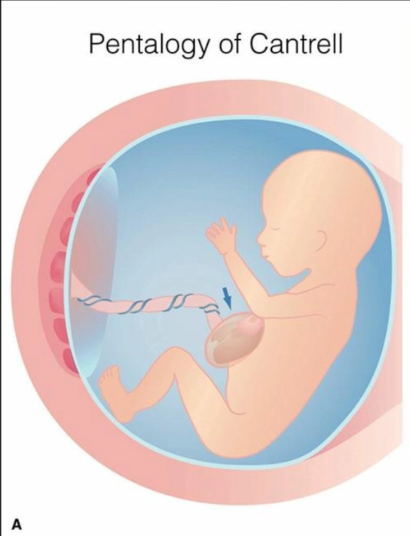 Ngũ chứng Cantrell thai quý I