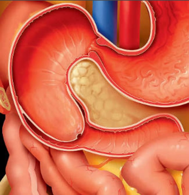 Tiêu hóa Nhi (Pediatric Gastrointestinal)