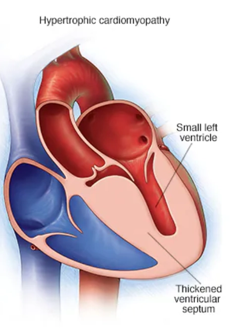 Bệnh cơ tim phì đại