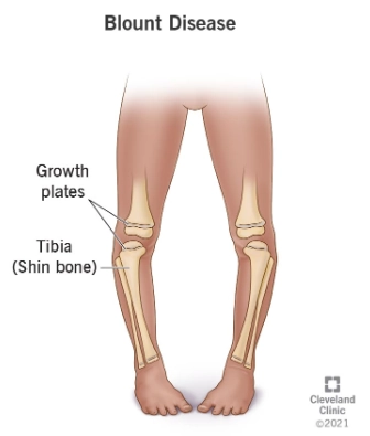Bệnh Blount (Chân vòng kiềng)