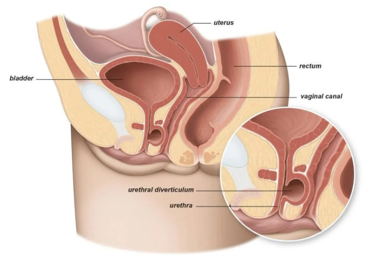 Túi thừa niệu đạo (Urethral diverticulum)