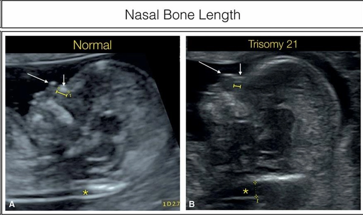 Bất thường mặt trong các dị tật thần kinh và lệch bội