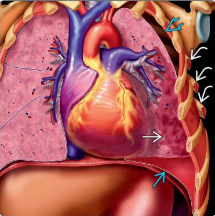 Chấn thương ngực và tổn thương phổi cấp (thoracic trauma &amp; acute lung injury)