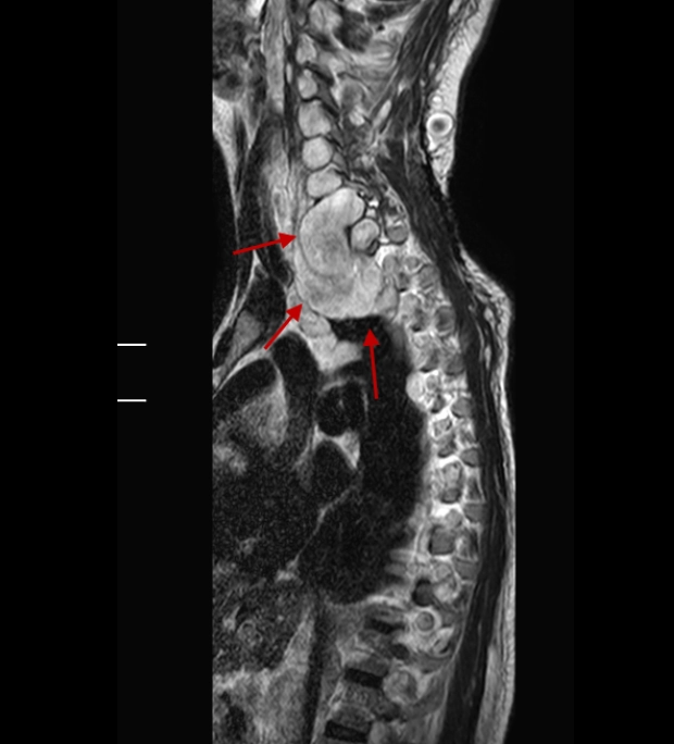 Bệnh đa u sợi thần kinh type 1 (Neurofibromatosis type 1 - NF1)