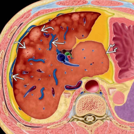 Hội chứng Budd-Chiari (Budd-Chiari syndrome)