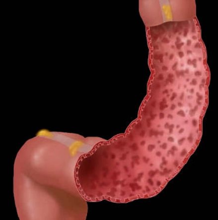 Viêm loét đại tràng (Ulcerative Colitis)