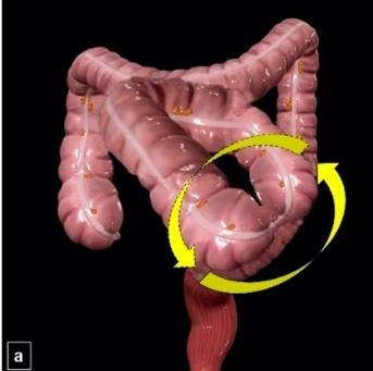 Xoắn ruột (volvulus)