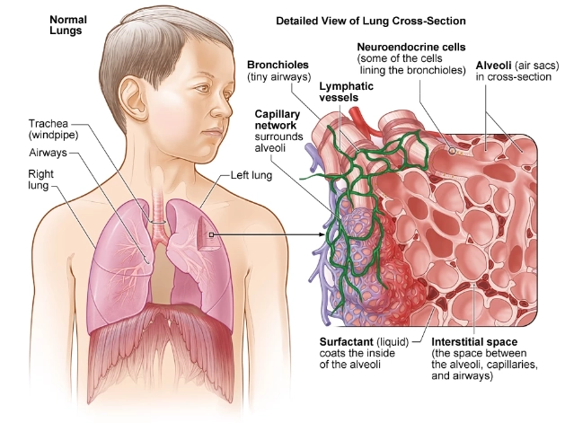 Viêm phổi quá mẫn (Hypersensitivity Pneumonitis - HP)