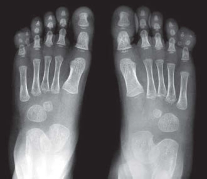 Cơ xương khớp Nhi (Pediatric MSK)